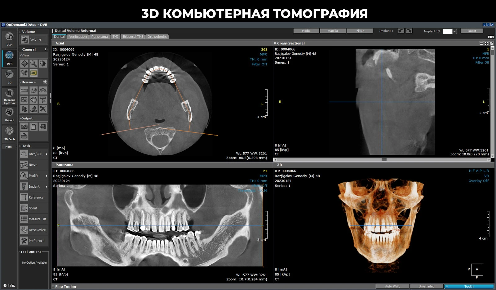 3D Rentgen