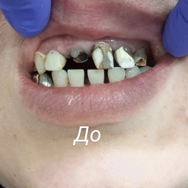 Hilol dent