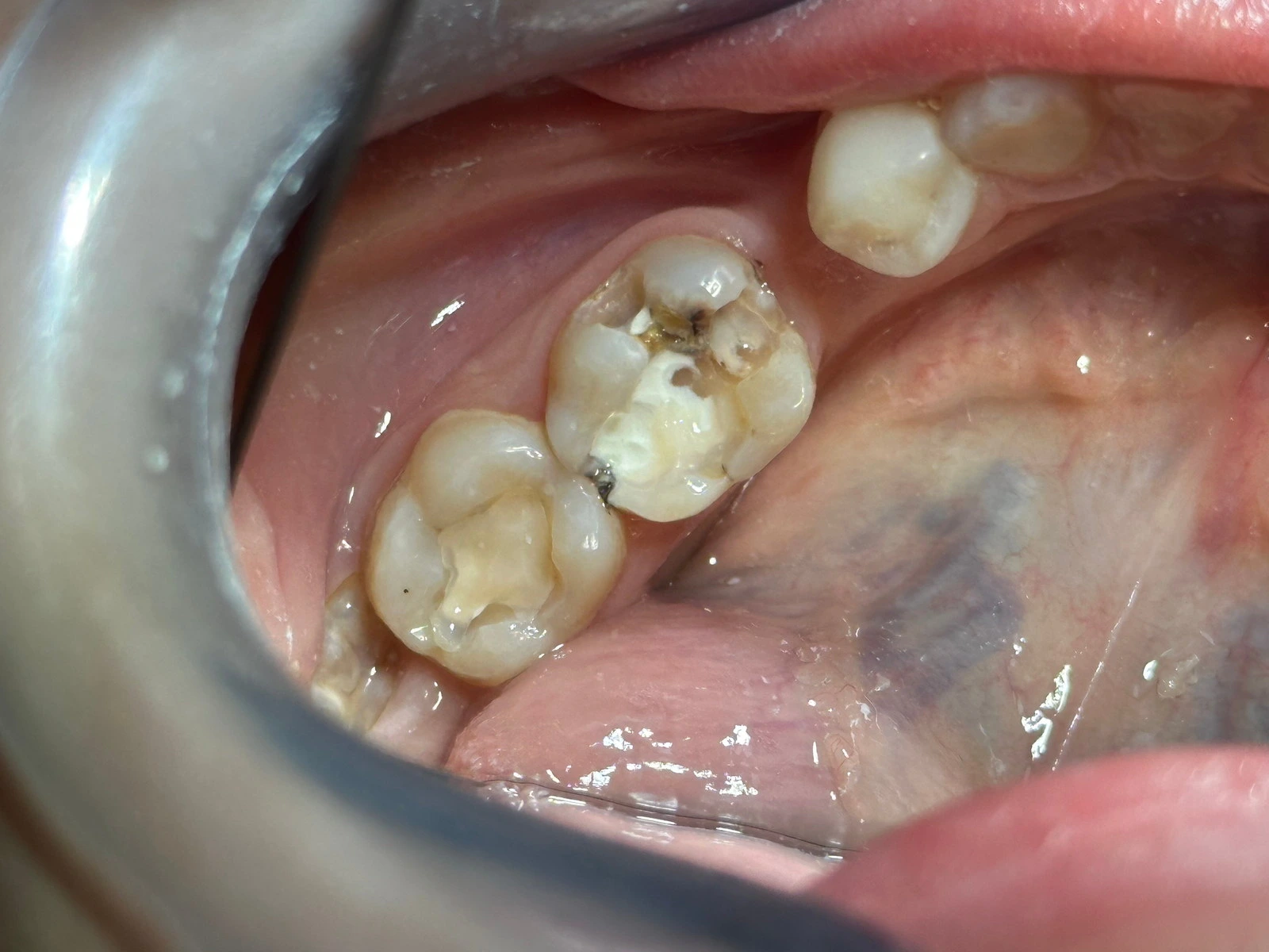Tinchlik Stoma Lyuks
